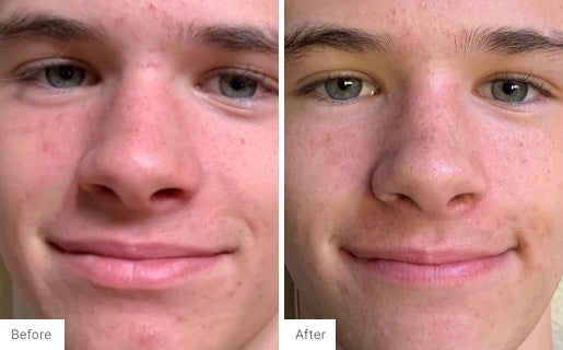 Acne Real Results Image 5